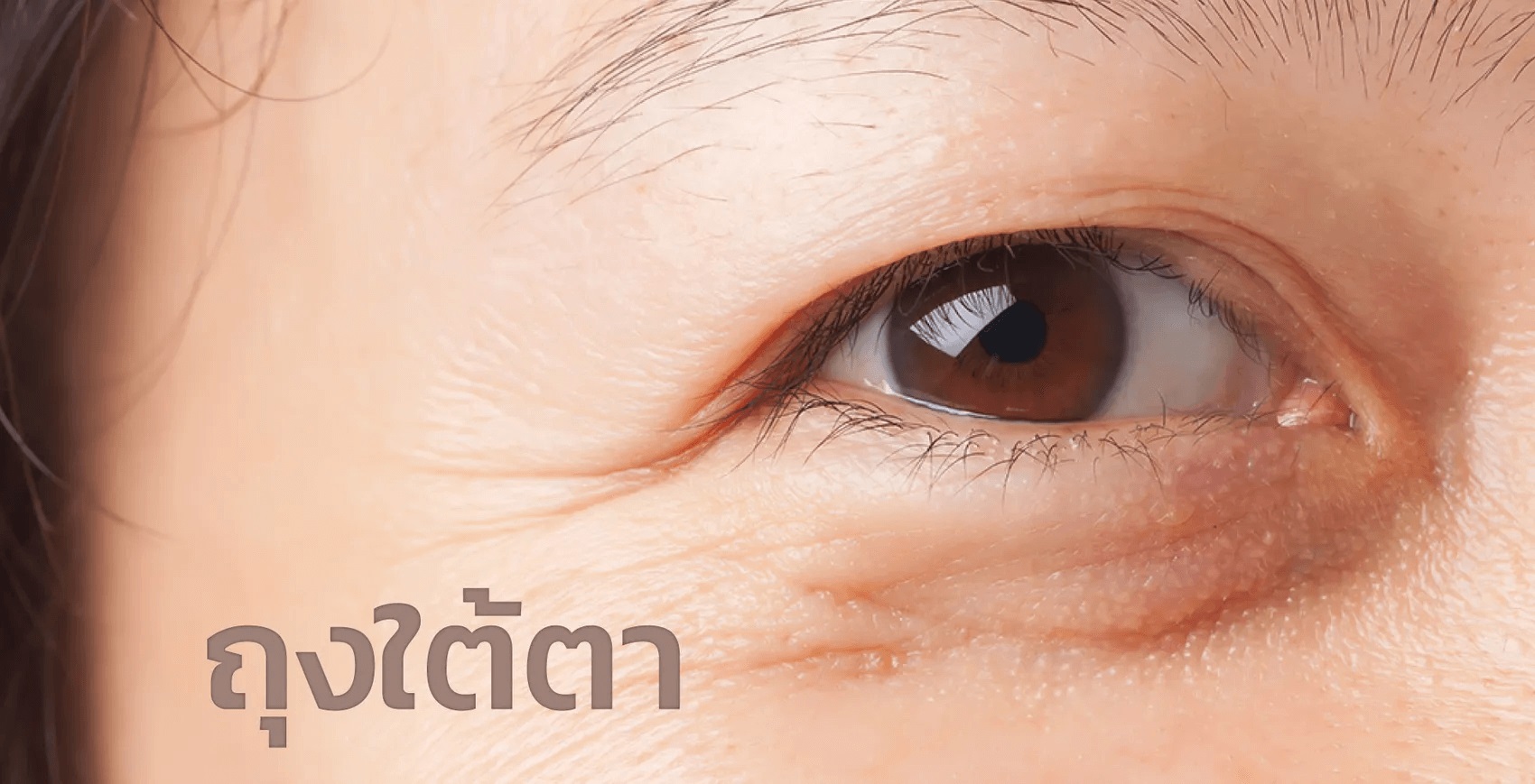 ถุงใต้ตาและร่องใต้ตา คืออะไร